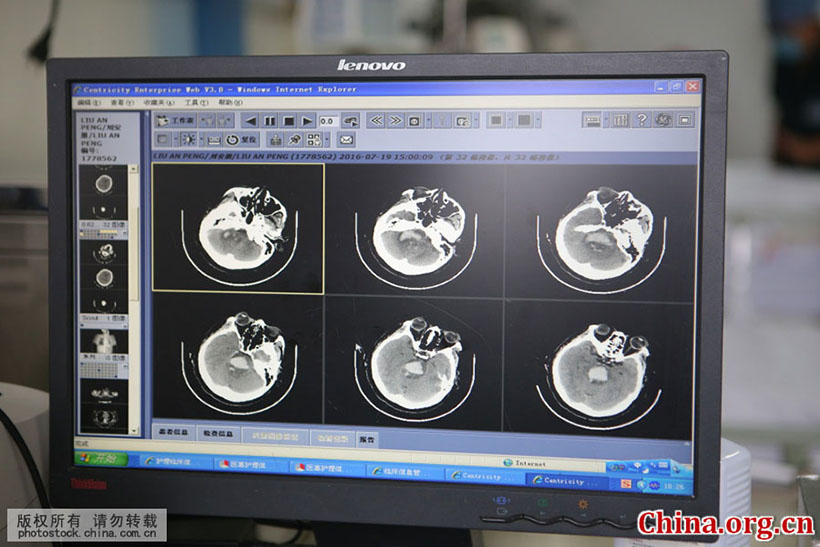 Cirurgia cerebral com tecnologia de impressão 3D é realizada em Shandong