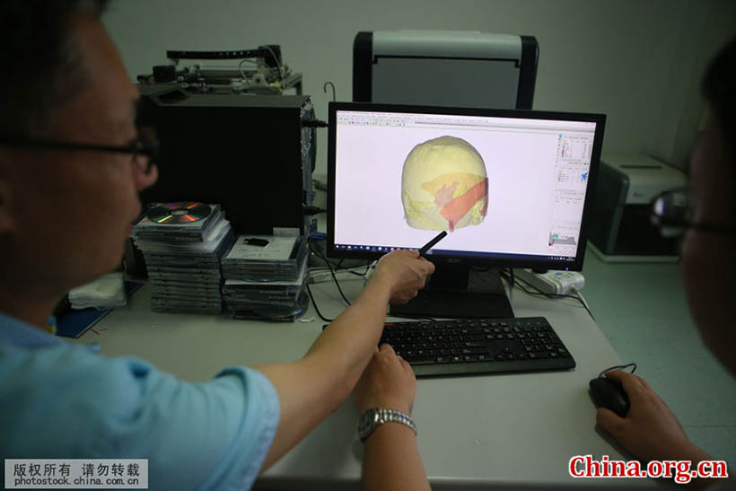 Cirurgia cerebral com tecnologia de impressão 3D é realizada em Shandong